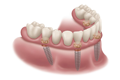 dentures over implants