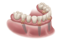 prothèse sur implants