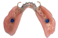 partial denture over implants